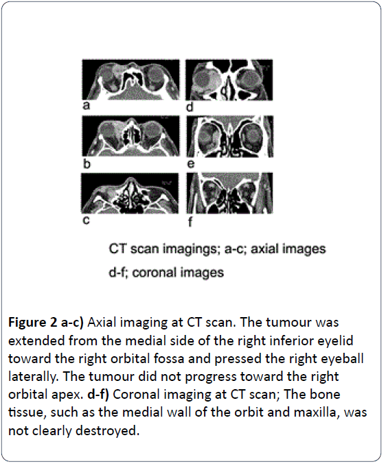head-neck-cancer-Axial-imaging