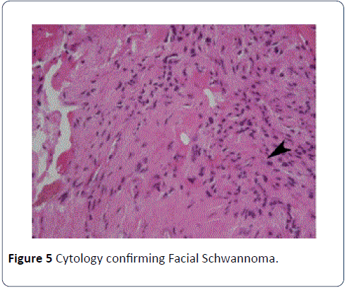 head-neck-cancer-Cytology-confirming