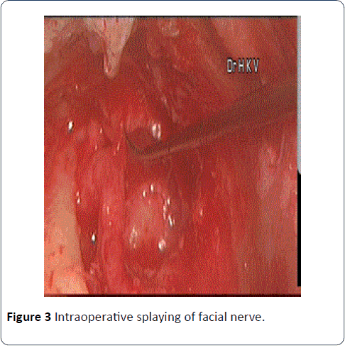 head-neck-cancer-Intraoperative