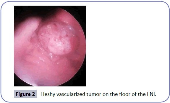head-neck-cancer-research-Fleshy-vascularized-tumor