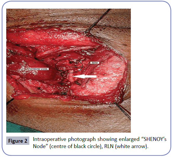 head-neck-cancer-research-Intraoperative-photograph-enlarged