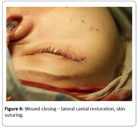 head-neck-cancer-research-Wound-closing