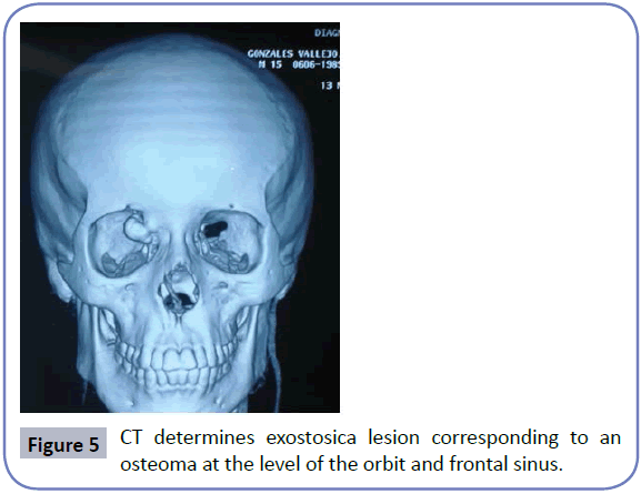 head-neck-cancer-research-exostosica-lesion-osteoma
