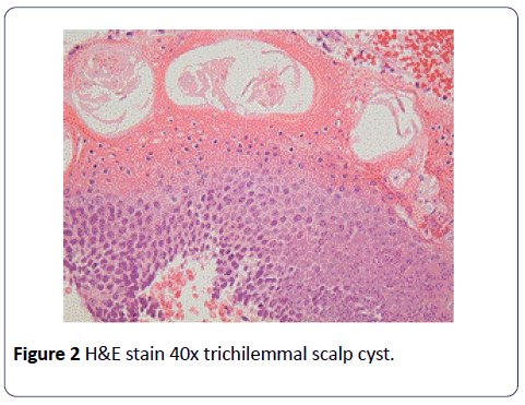 head-neck-cancer-research-trichilemmal-scalp