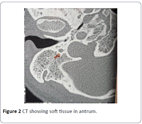 head-neck-cancer-soft-tissue