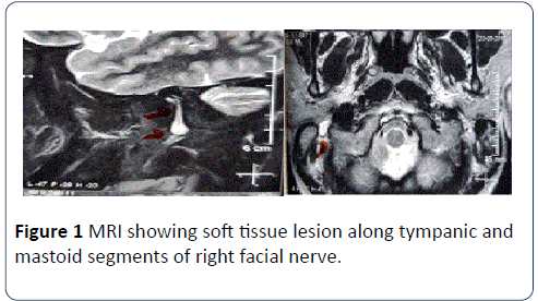 head-neck-cancer-tissue-lesion